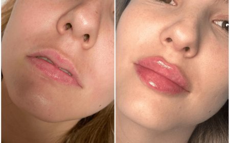 Juvederm for Feminine Contours: Tips from the Best Doctors in Dubai