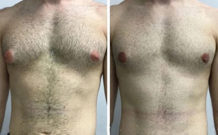 Gynecomastia in Dubai and Body Image: Psychological Impacts and Solutions