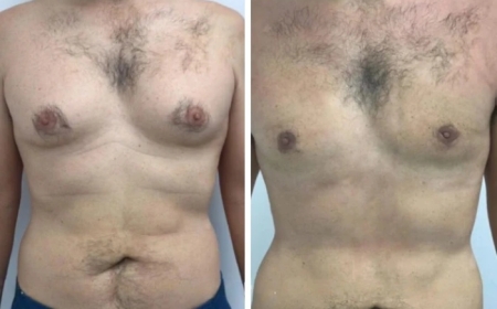 How to Find the Best Gynecomastia Surgeons in dubai: A Comprehensive Guide