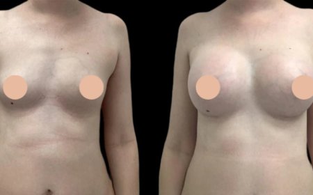 Breast Augmentation in Dubai: Before & After You Should See