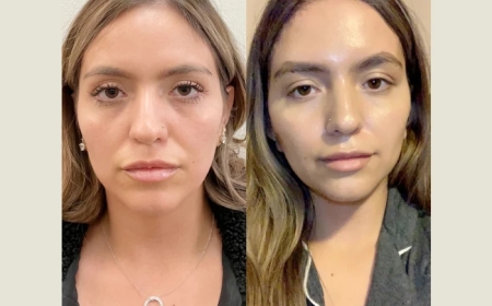 Best Doctors in Dubai for Thread Lift: How Long Do the Results Last