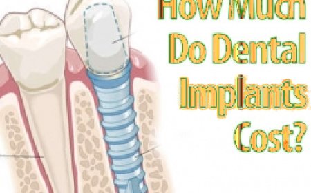 How Much Do Dental Implants Cost in Delhi? A Complete Guide