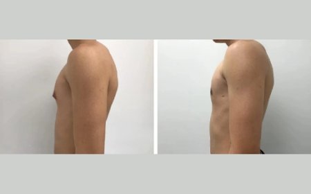 Who Needs Gynecomastia Surgery in Dubai