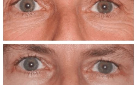 What Makes Eye Bag Removal Surgery in Dubai Popular?