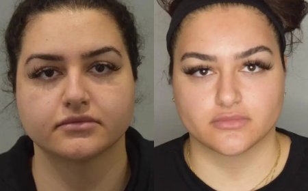 Is Buccal Fat Removal Surgery in Dubai Right for You?