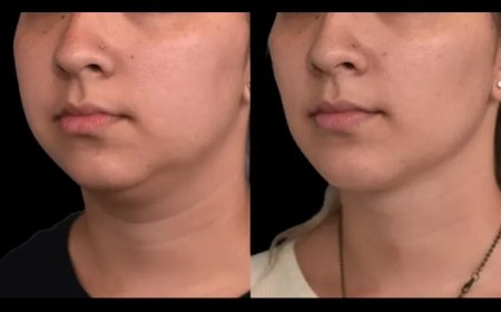 Post-Surgery Care for Double Chin Removal Surgery in Dubai