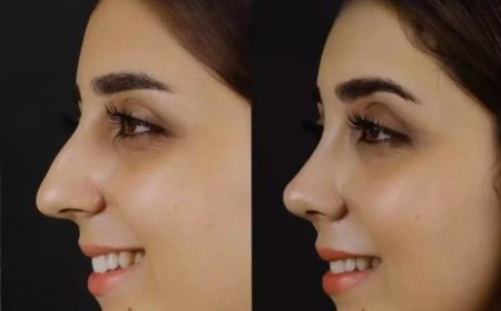 Best Septoplasty Surgeons in Dubai: What Makes Them Stand Out?