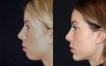 Best Doctors in dubai for Chin Fillers: Achieve the Perfect Chin Without Surgery