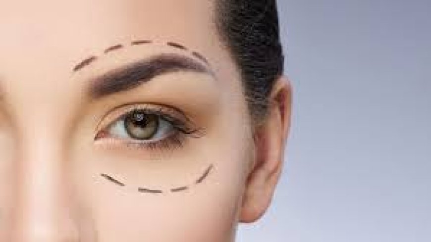 Upper Blepharoplasty in Jeddah: Brighten and Rejuvenate Tired Eyes