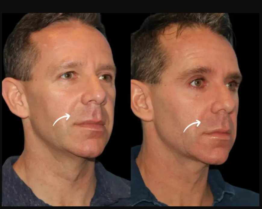 Best Doctors in Dubai on Seasonal Timing for Sculptra Fillers