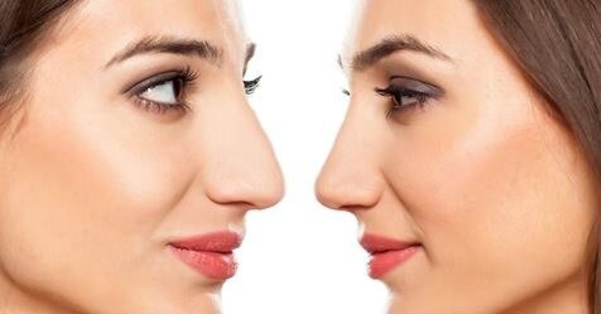 Discover the Art of Ethnic Rhinoplasty in NYC: Tailored Beauty with Cultural Respect