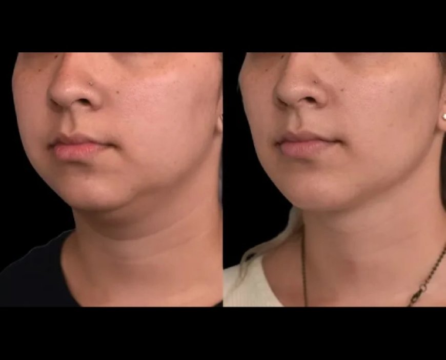 Post-Surgery Care for Double Chin Removal Surgery in Dubai