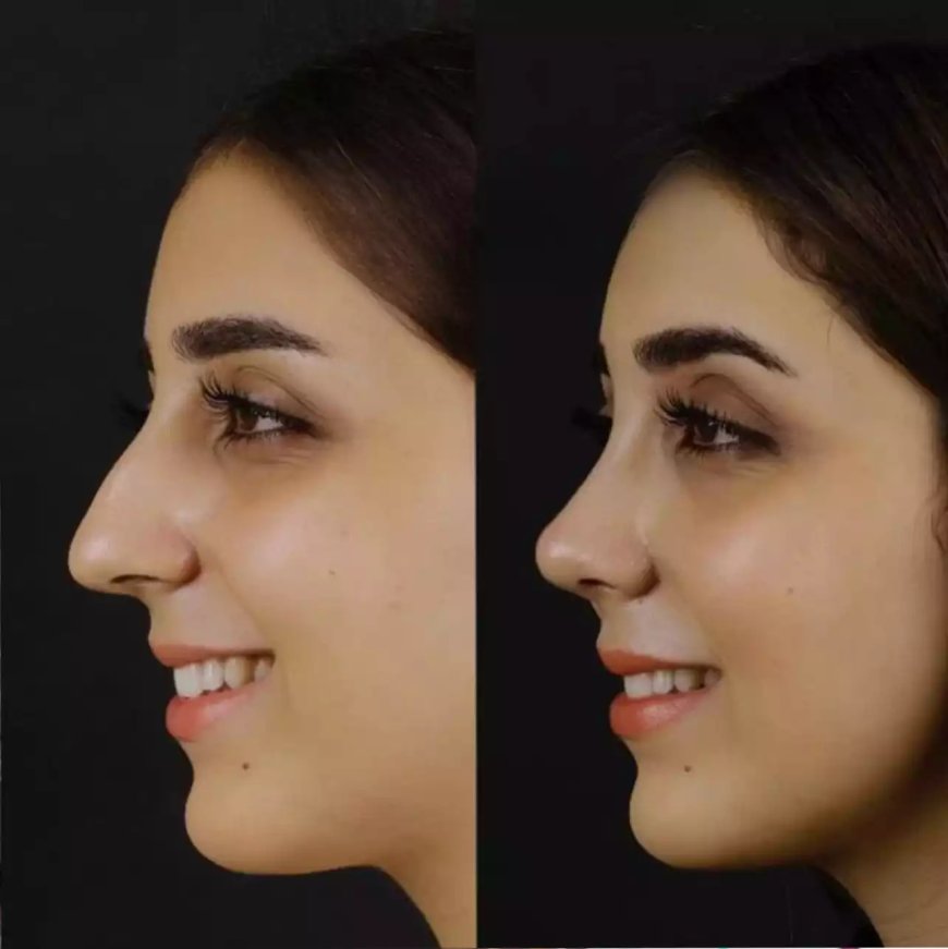 Best Septoplasty Surgeons in Dubai: What Makes Them Stand Out?