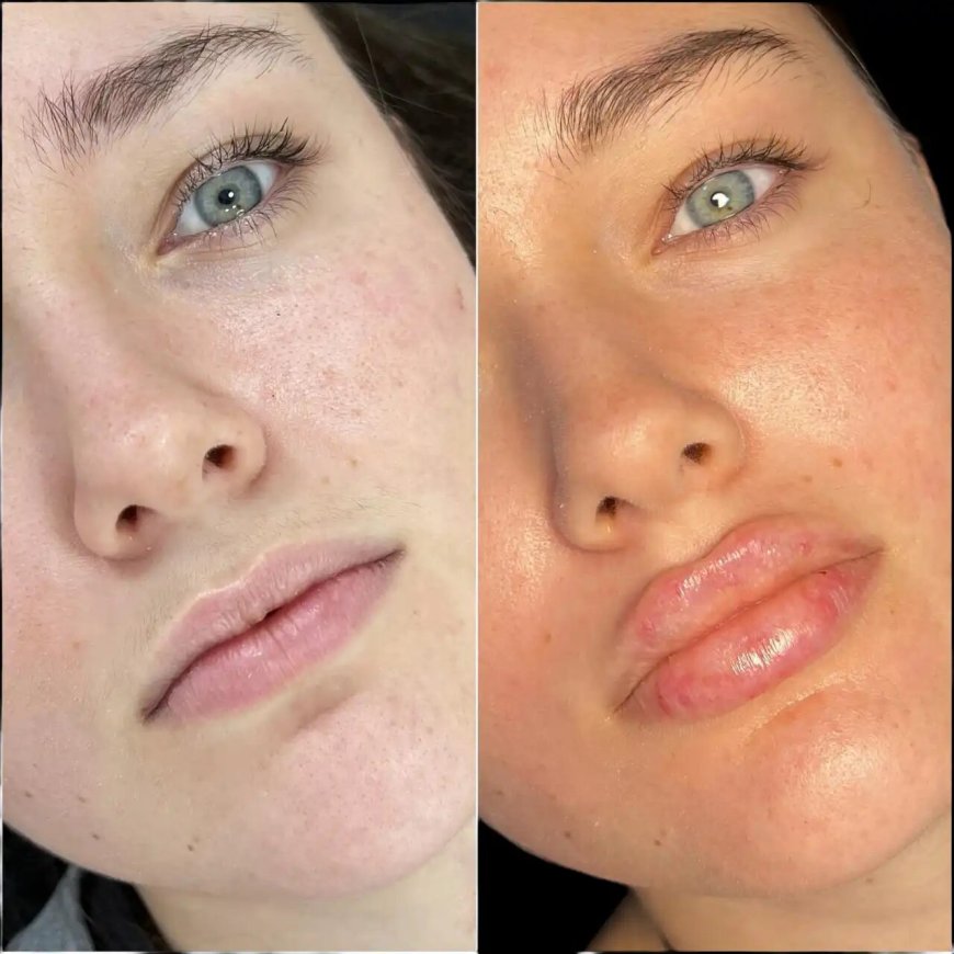 Best Doctors in dubai for Fillers: How to Achieve Subtle Enhancements