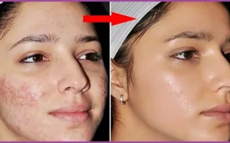 Prescription Acne Medication, Acne Treatments, and Scar Revision Surgery Near Me in Naperville