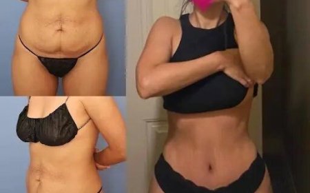 What to Expect During Your Tummy Tuck Consultation in Dubai