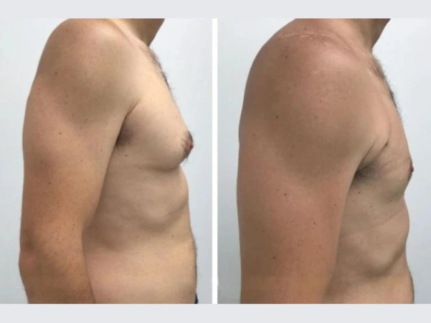 Why the Best Doctors in Dubai Offer Personalized Care for Gynecomastia Surgery