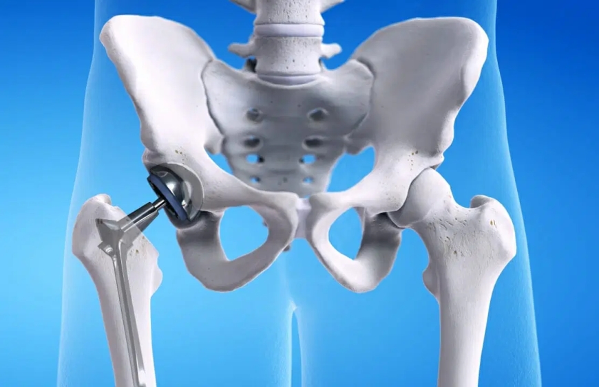Hip Pain? Book an Appointment with the Best Hip Replacement Surgeon in Jaipur
