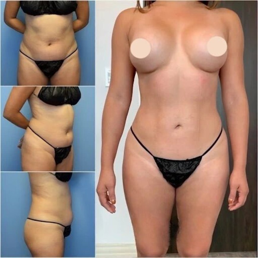 Why Body Contouring in Dubai Is a Game Changer for Your Confidence