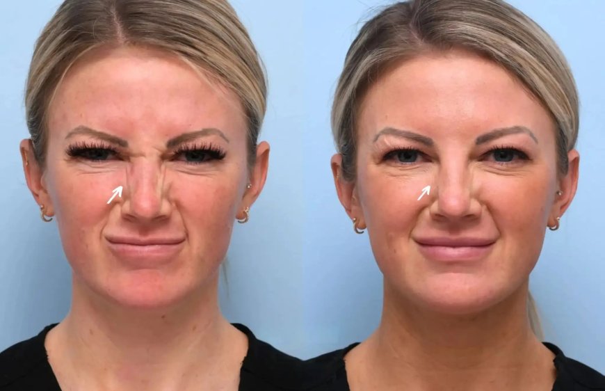 What Sets the Best Plastic Surgeons in Dubai Apart When It Comes to Botox Treatments
